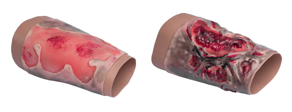 Комплект муляжів з опіками кінцівок 2-3 та 3-4 ступенів