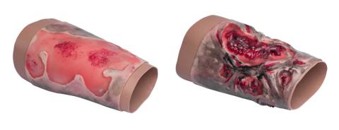 Комплект муляжів з опіками кінцівок 2-3 та 3-4 ступенів